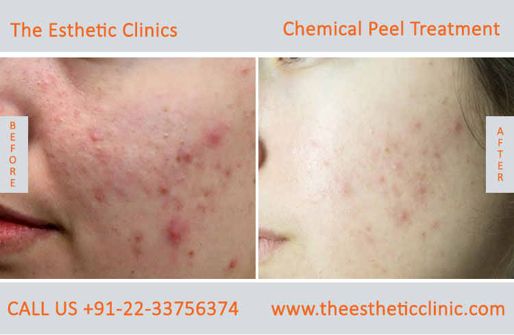 Chemical Peels Treatment before after photos in mumbai india (4)